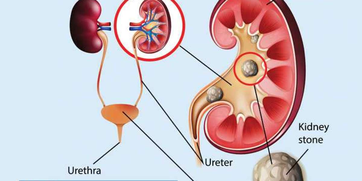 KIDNEY STONES: SYMPTOMS, CAUSES, DIAGNOSIS AND TREATMENTS - RANTWE
