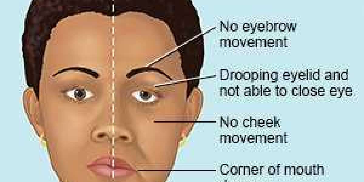 BELL'S PALSY: SYMPTOMS, CAUSES, DIAGNOSIS, AND TREATMENTS - RANTWE